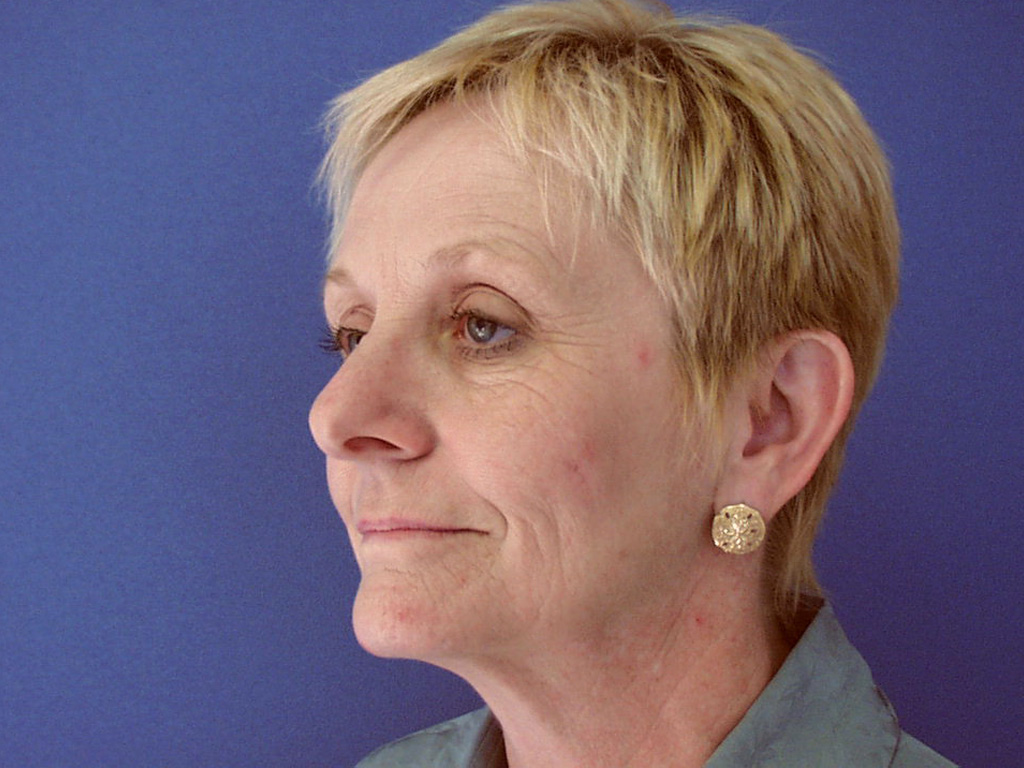 Before Image: Patient Case #0122 - left-front-oblique