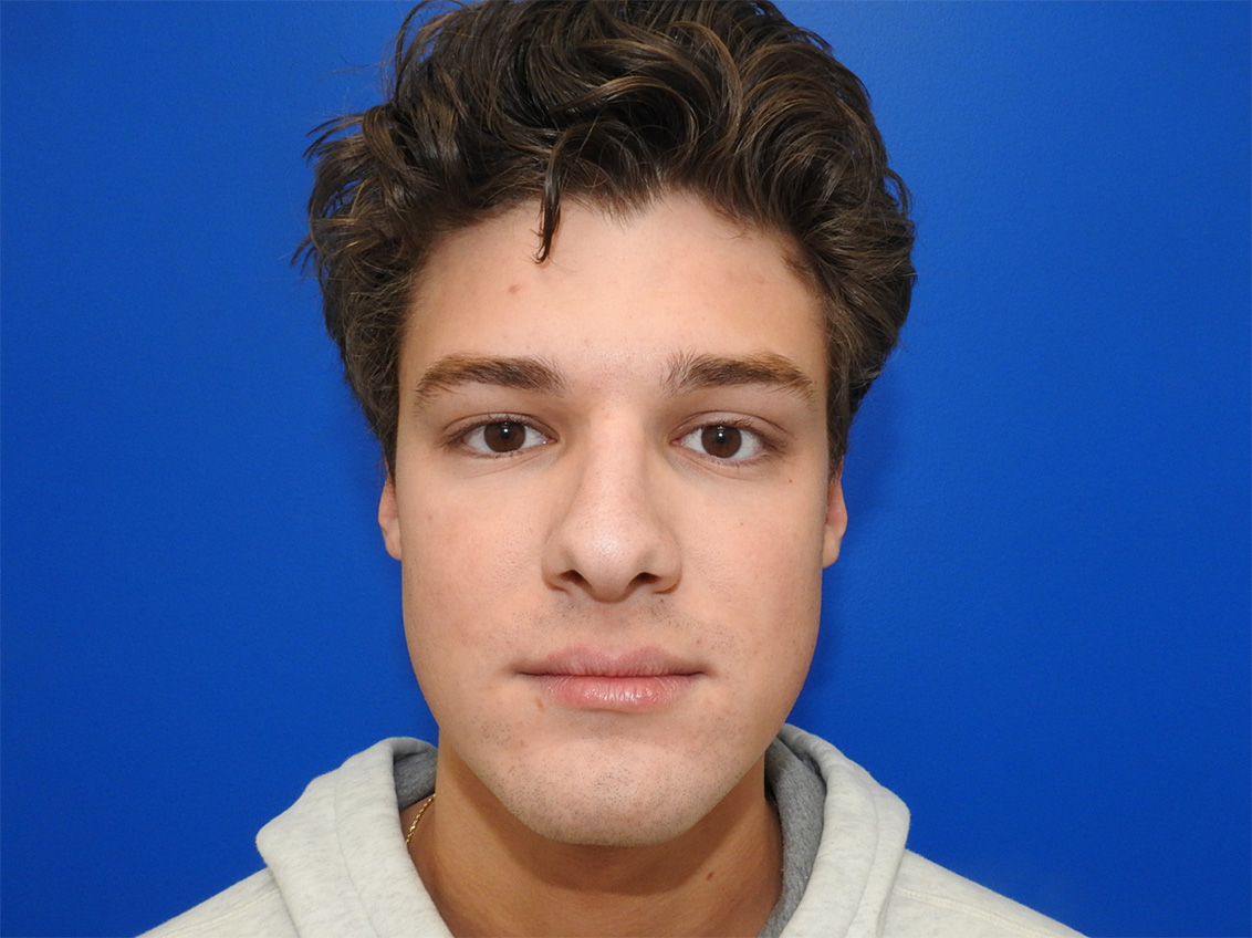 After Image: Patient Case #0106 - front