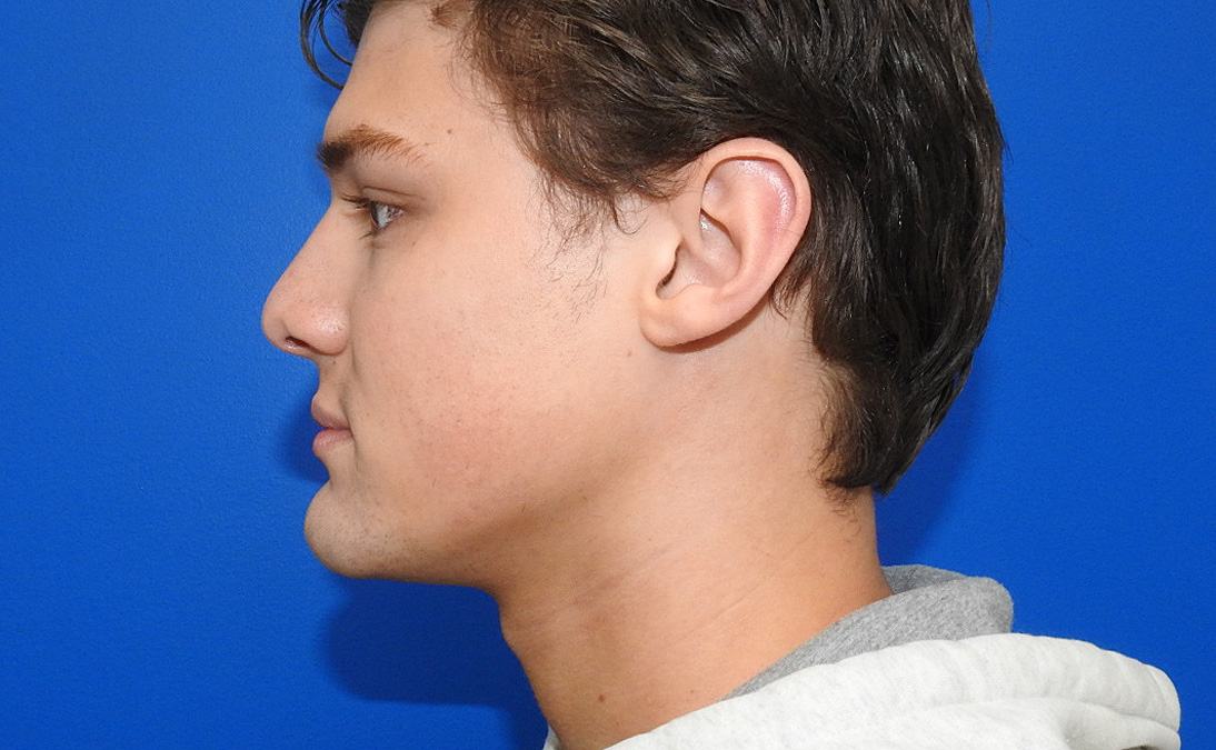 After Image: Patient Case #0106 - left-side