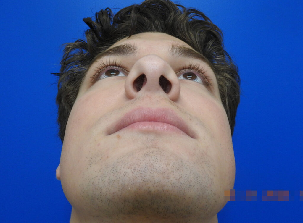 After Image: Patient Case #0106 - front