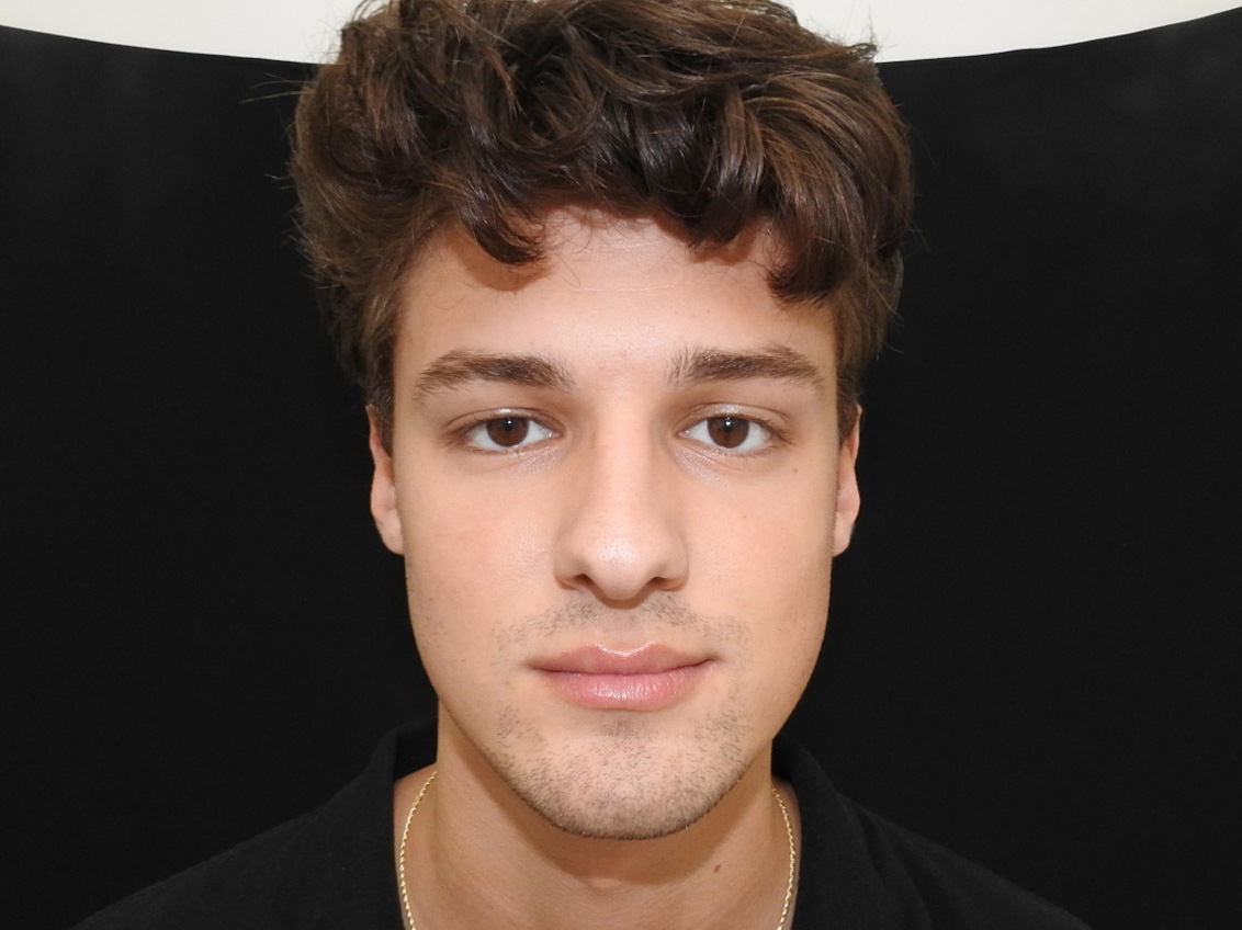 Before Image: Patient Case #0106 - front