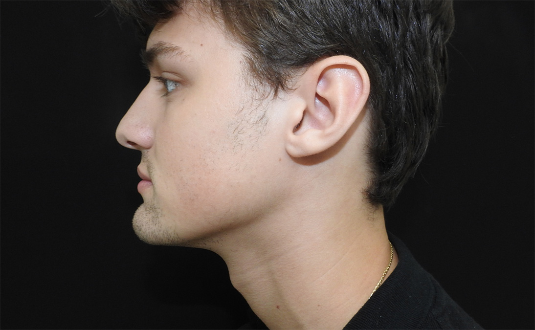 Before Image: Patient Case #0106 - left-side