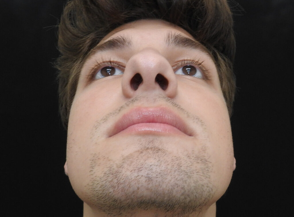 Before Image: Patient Case #0106 - front