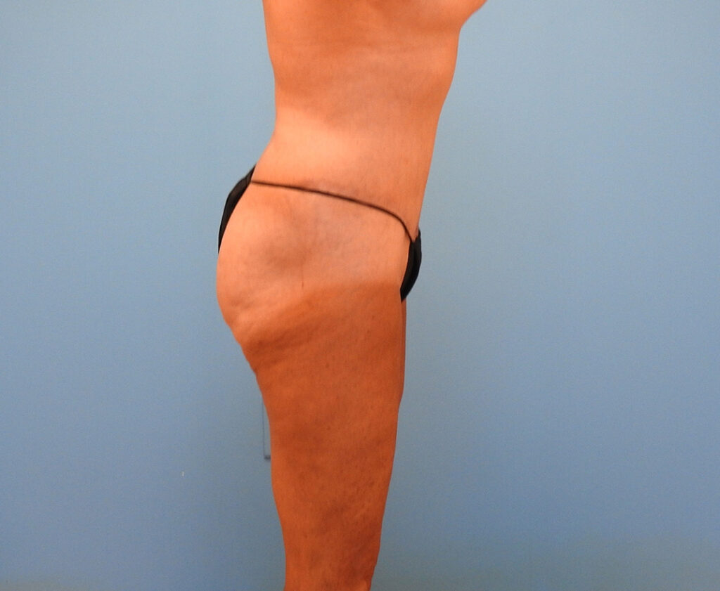 After Image: Patient Case #0143 - right-side