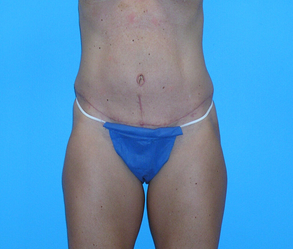 After Image: Patient Case #1164 - front
