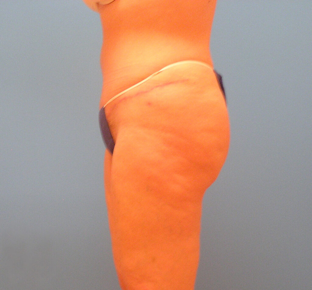 After Image: Patient Case #1126 - left-side