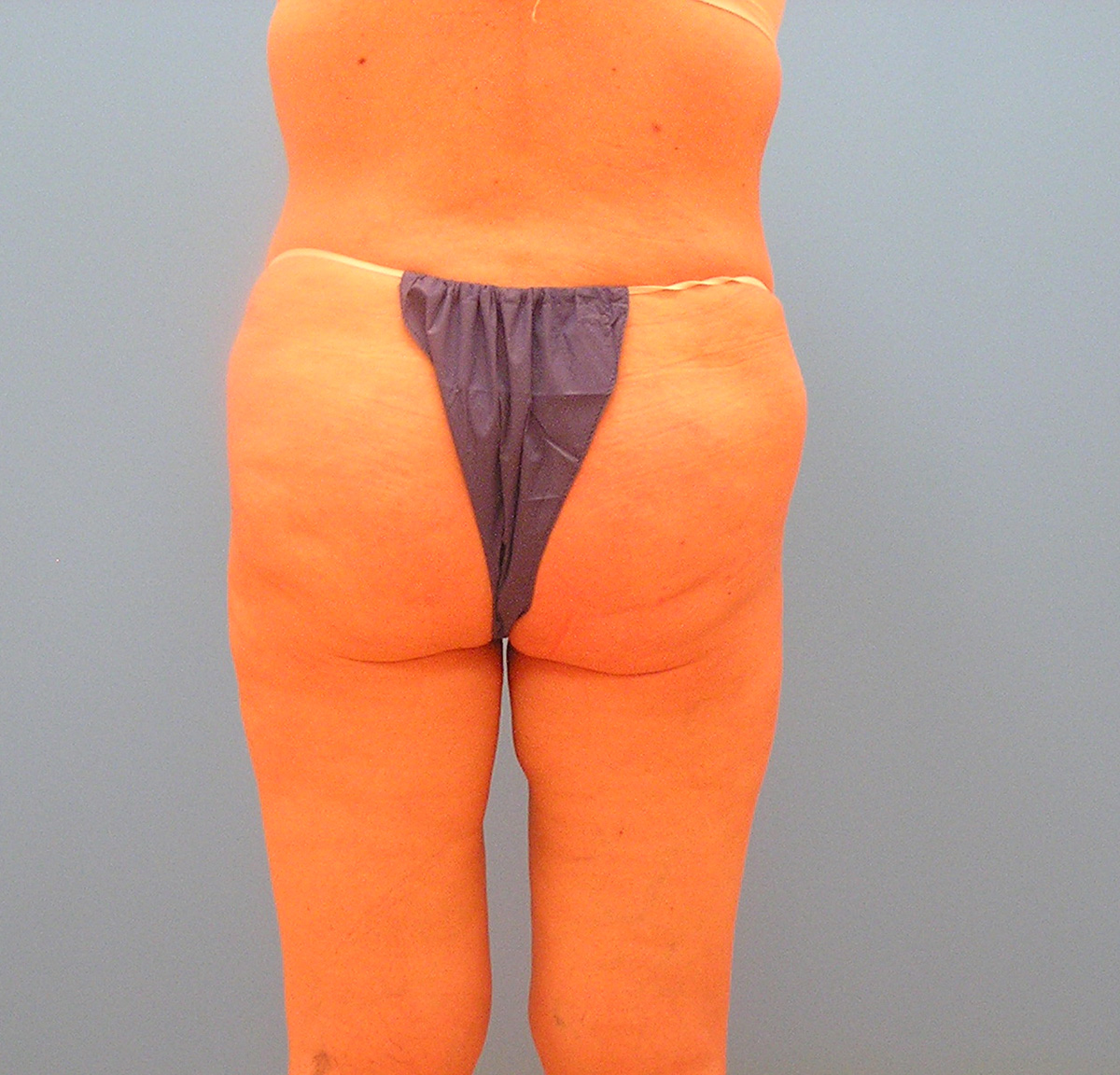 After Image: Patient Case #1126 - back