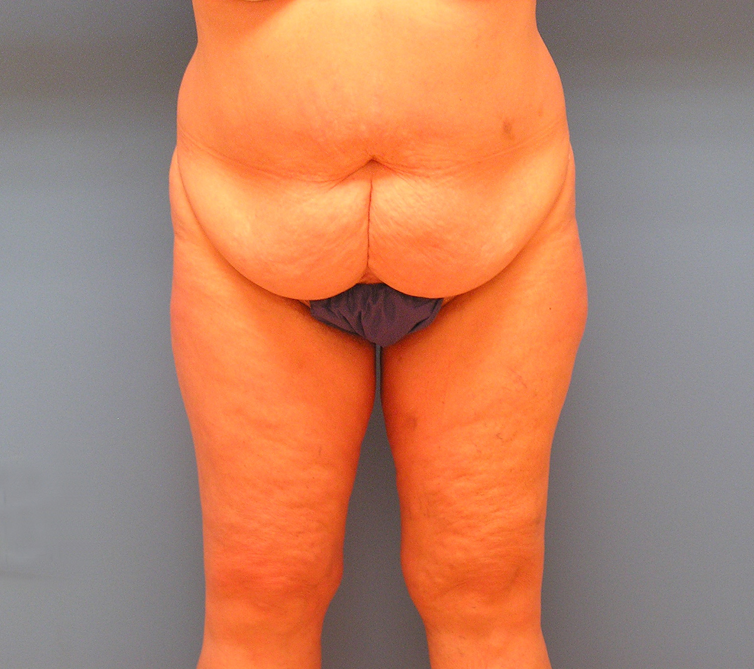Before Image: Patient Case #1126 - front