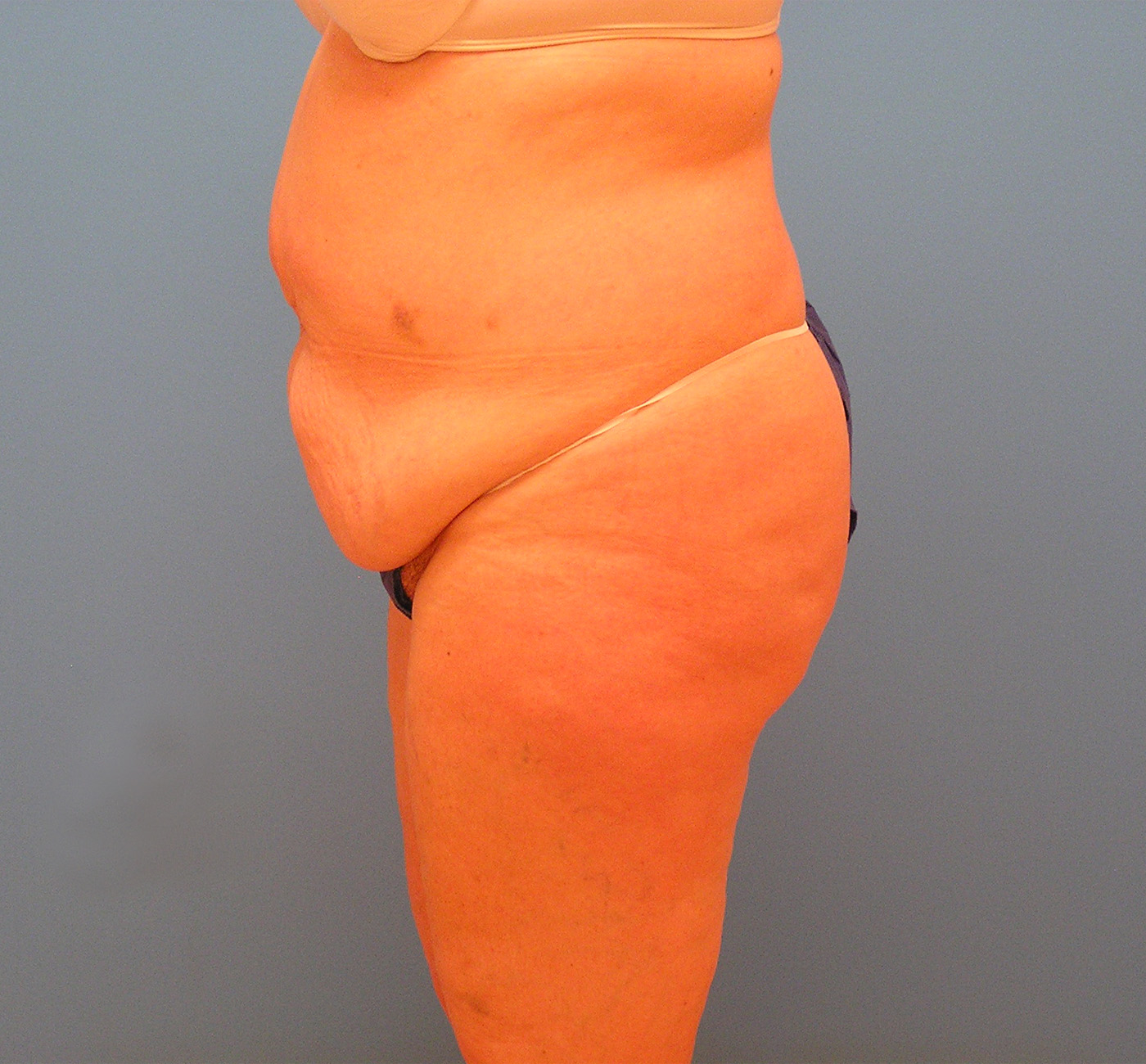 Before Image: Patient Case #1126 - left-side