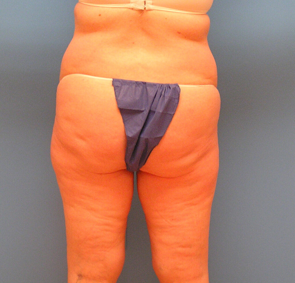 Before Image: Patient Case #1126 - back