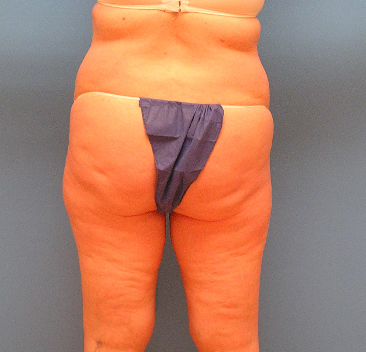 Before Image: Patient Case #1126 - back