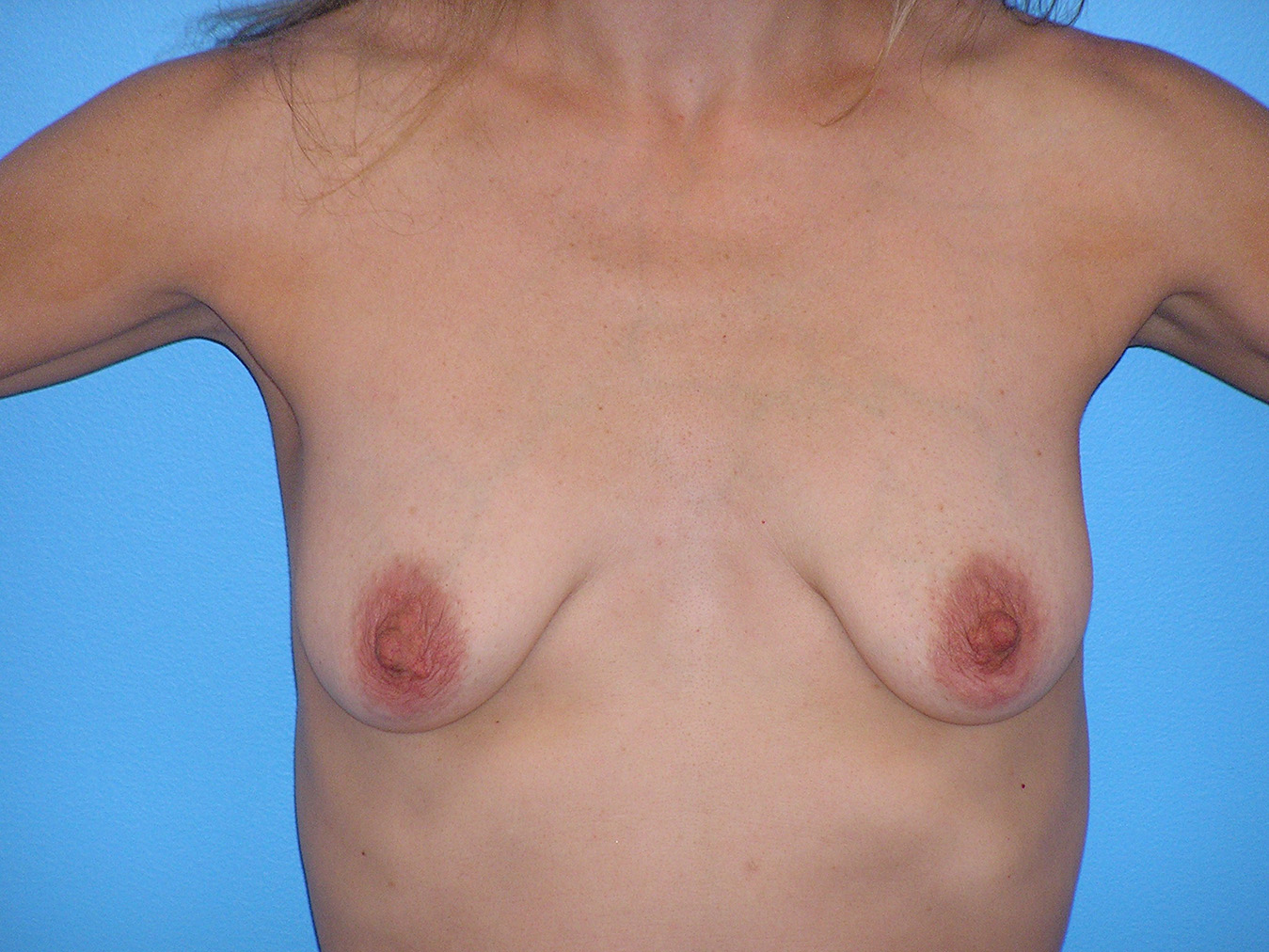 Before Image: Patient Case #130 - front