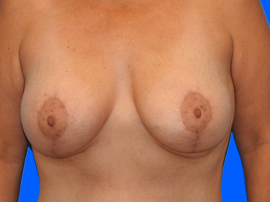 After Image: Patient Case #0140 - front