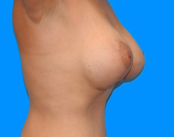 After Image: Patient Case #0140 - right-side