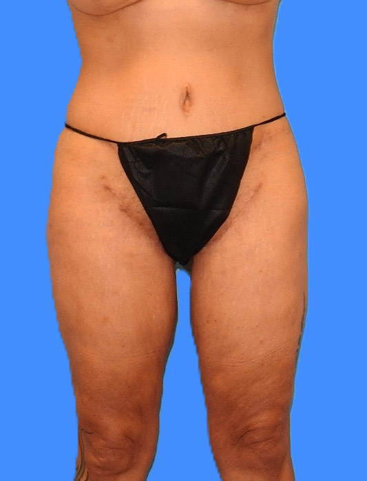 After Image: Patient Case #0140 - front