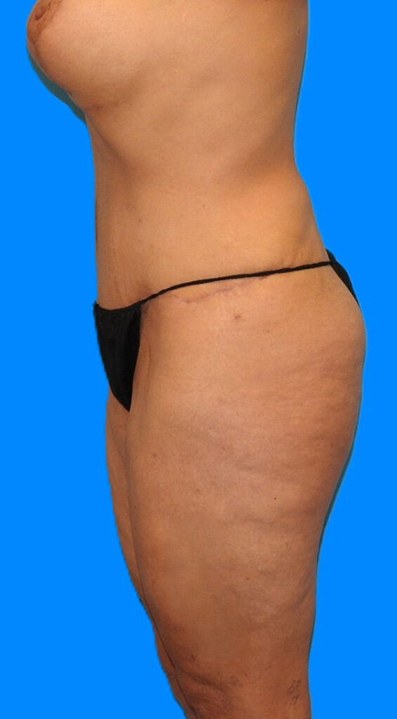 After Image: Patient Case #0140 - left-side