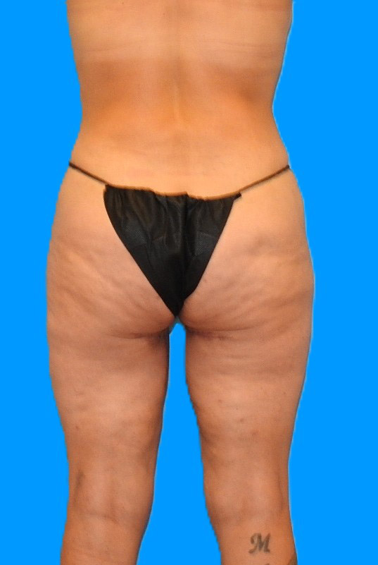 After Image: Patient Case #0140 - back