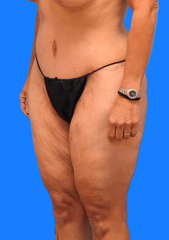 After Image: Patient Case #0140 - left-front-oblique