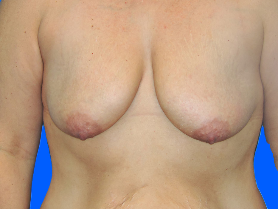Before Image: Patient Case #0140 - front