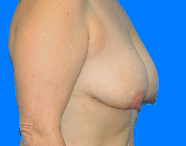 Before Image: Patient Case #0140 - right-side