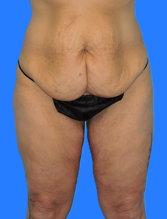 Before Image: Patient Case #0140 - front