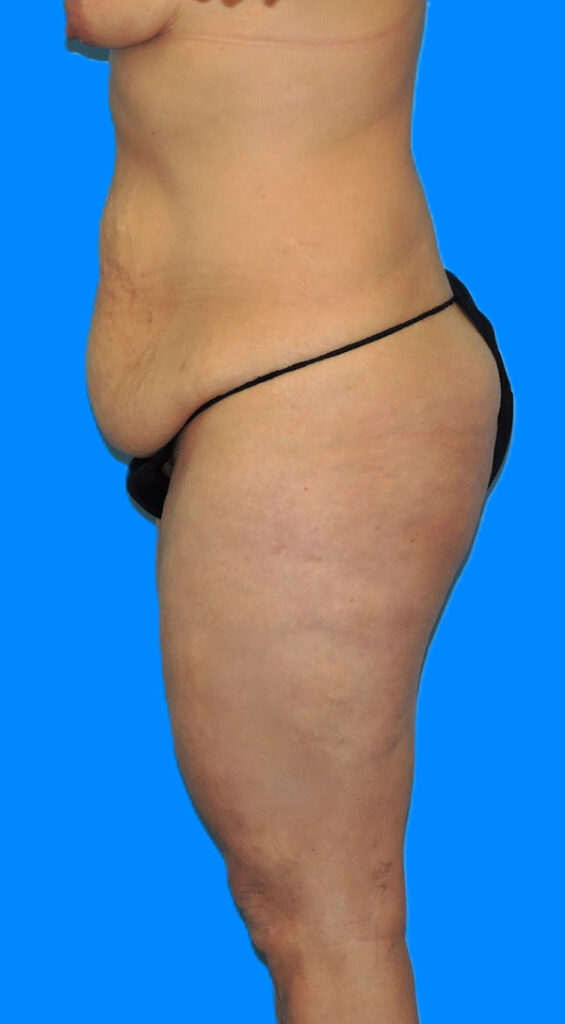 Before Image: Patient Case #0140 - left-side