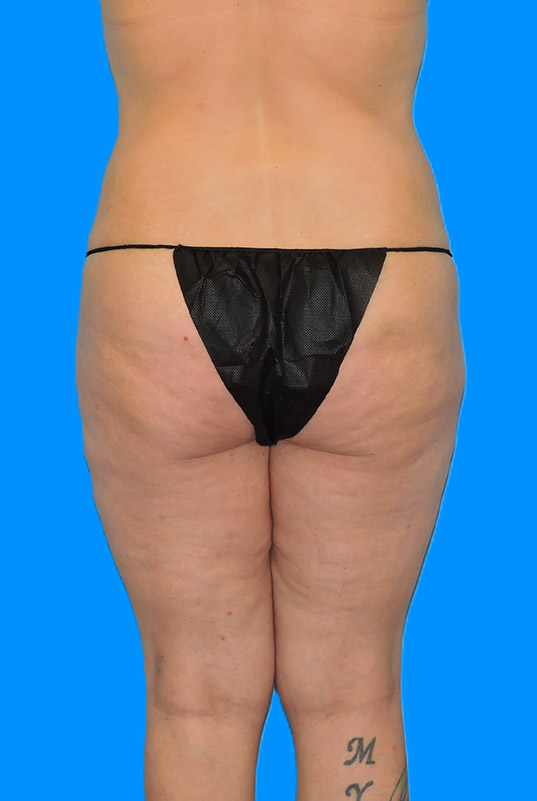 Before Image: Patient Case #0140 - back
