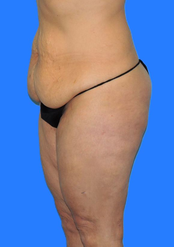 Before Image: Patient Case #0140 - left-front-oblique