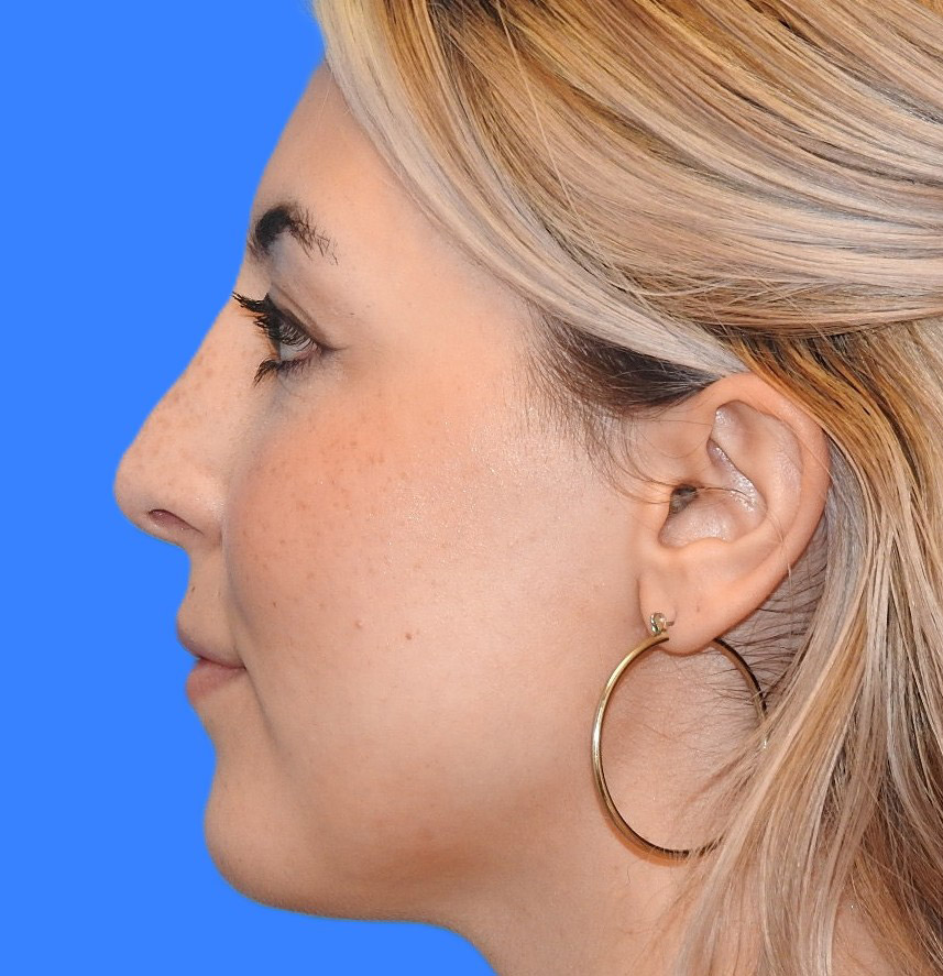 After Image: Patient Case #0198 - left-side