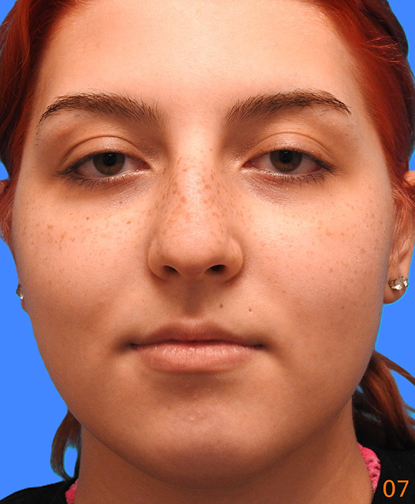 Before Image: Patient Case #0198 - front