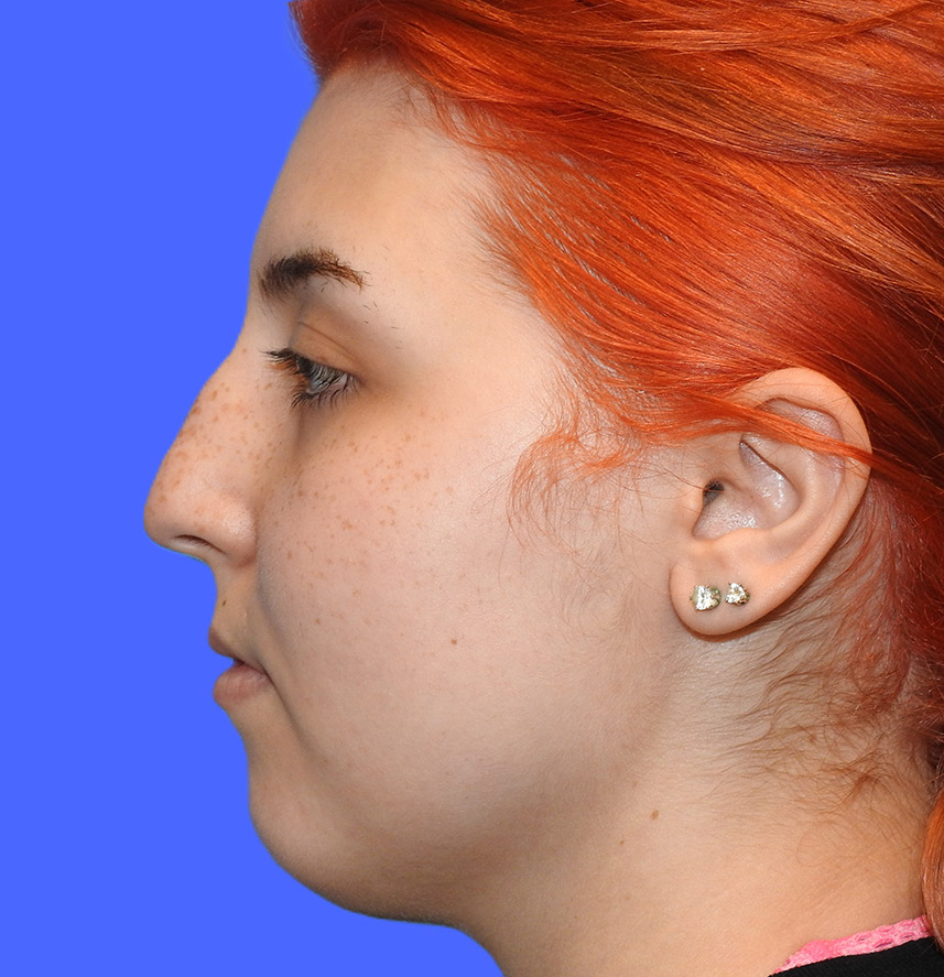 Before Image: Patient Case #0198 - left-side