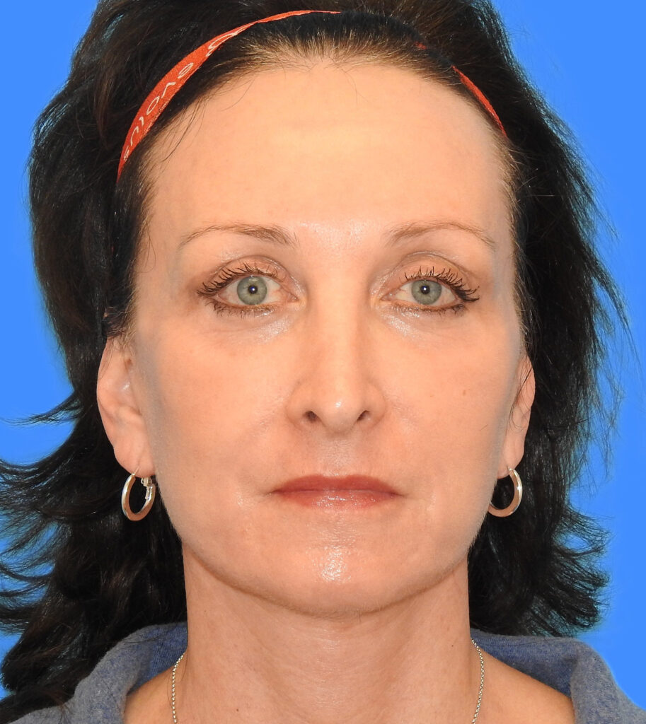 After Image: Patient Case #0188 - front