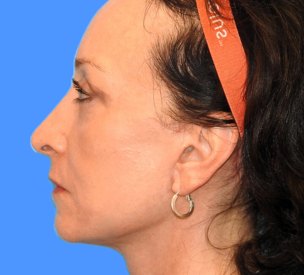After Image: Patient Case #0188 - left-front-oblique