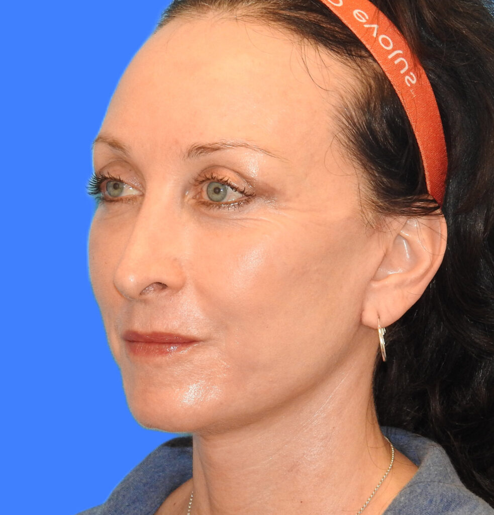 After Image: Patient Case #0188 - front