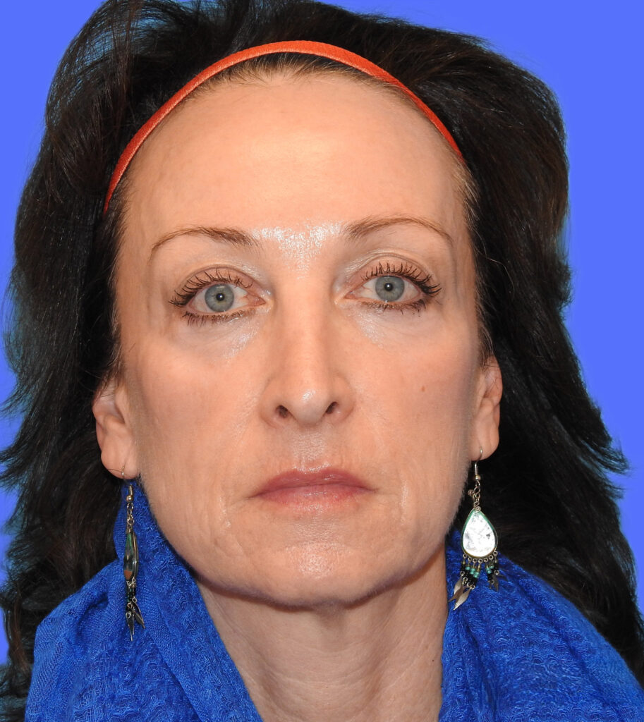 Before Image: Patient Case #0188 - front