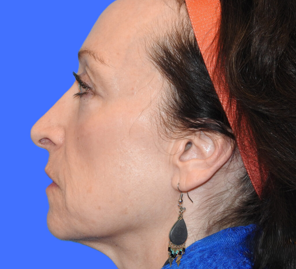 Before Image: Patient Case #0188 - left-front-oblique