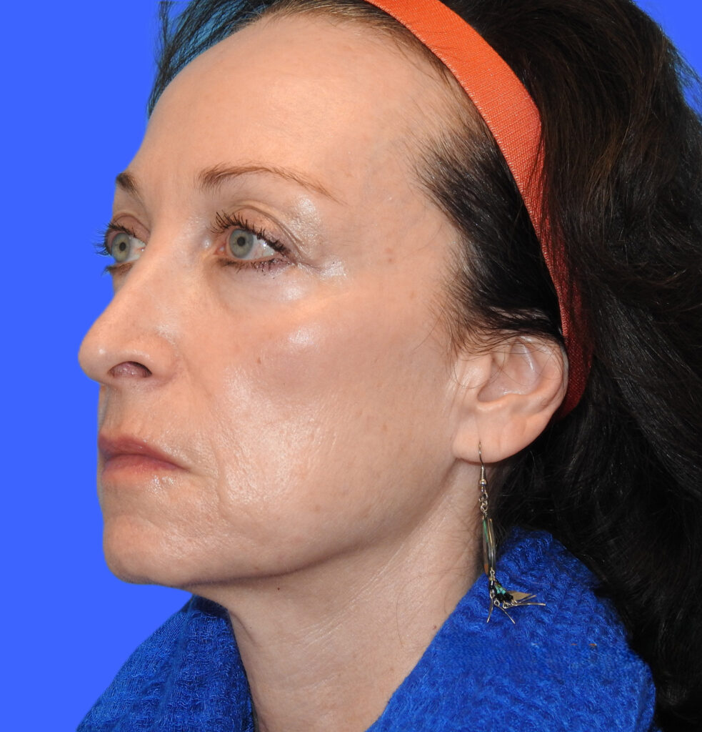 Before Image: Patient Case #0188 - front