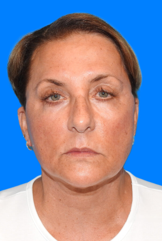 After Image: Patient Case #0190 - front
