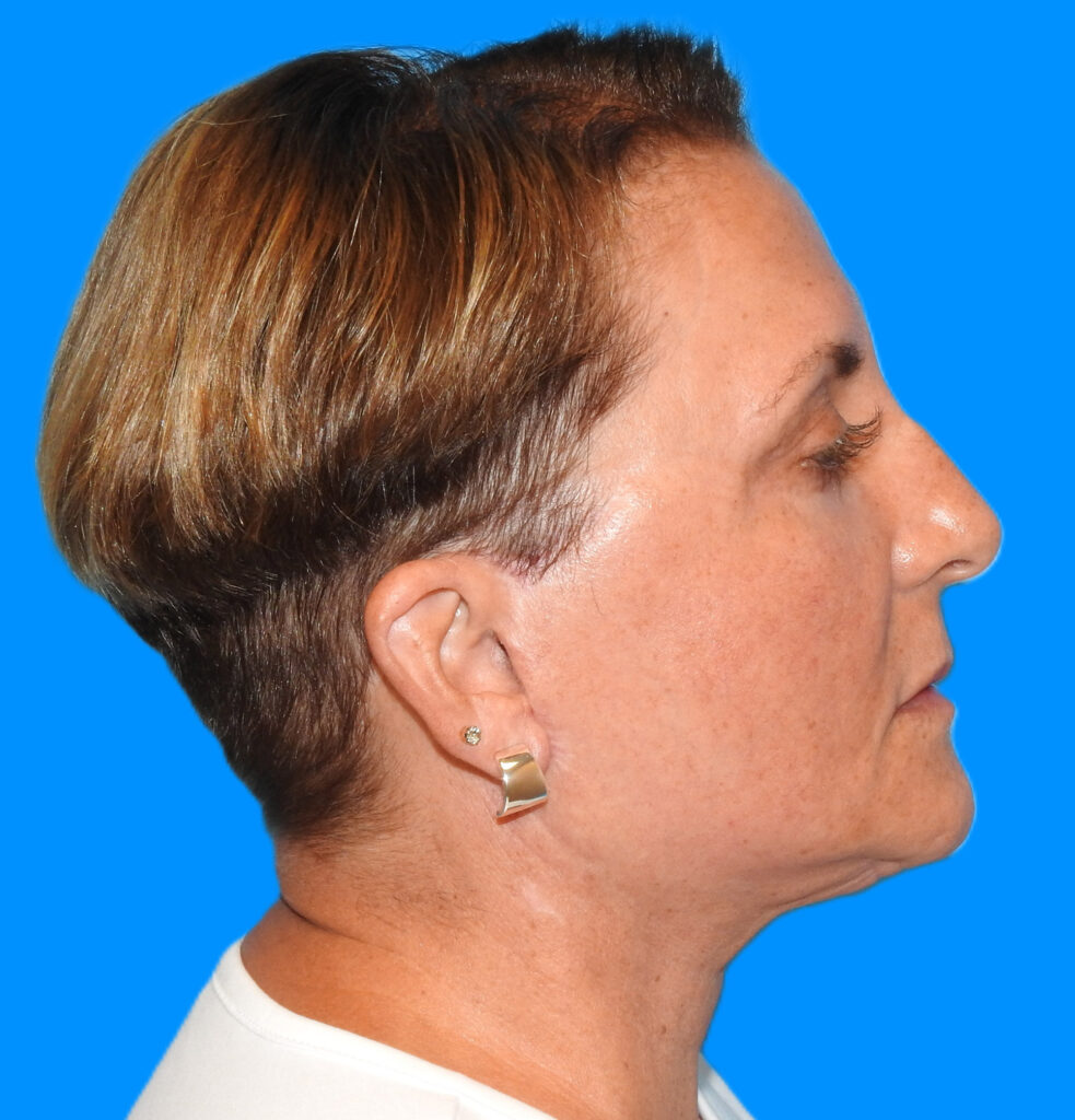 After Image: Patient Case #0190 - right-side