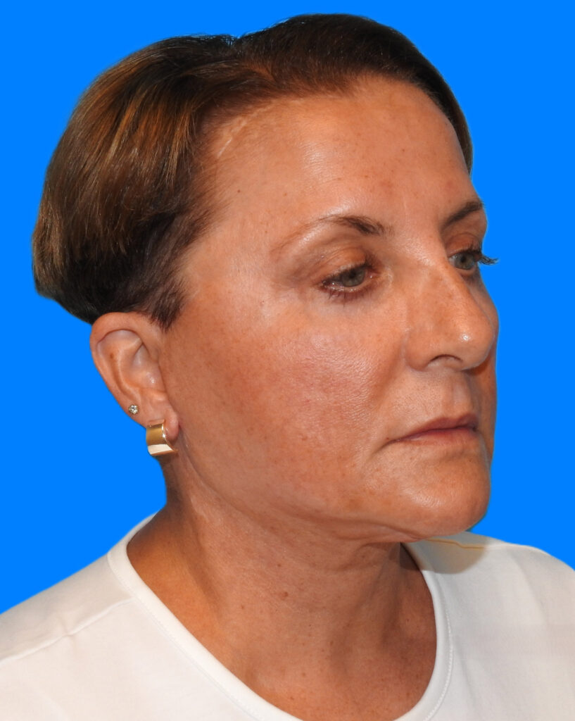 After Image: Patient Case #0190 - right-front-oblique
