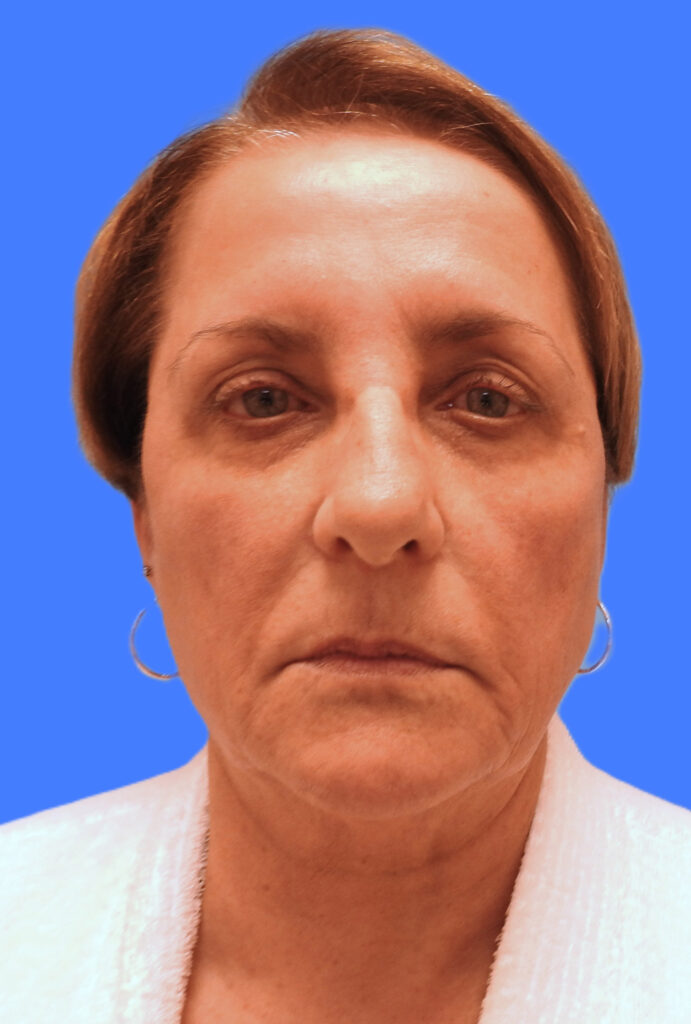 Before Image: Patient Case #0190 - front