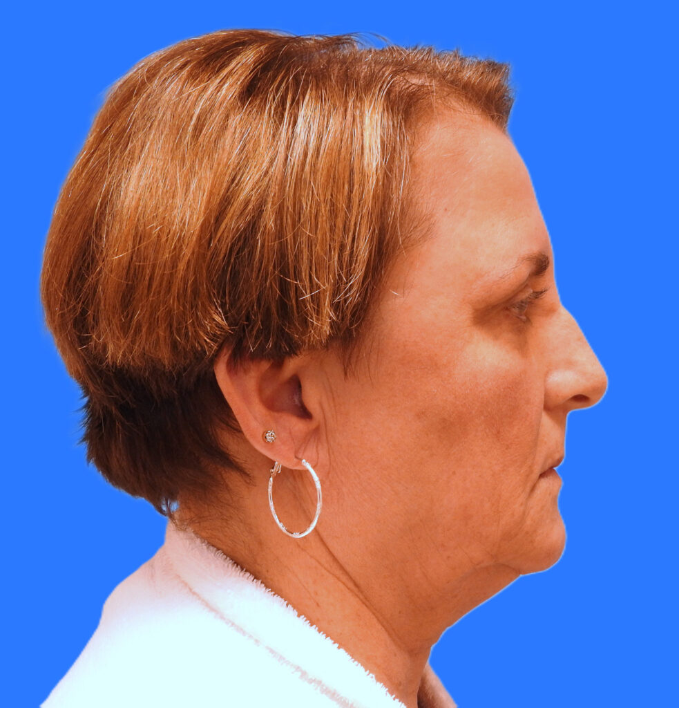 Before Image: Patient Case #0190 - right-side