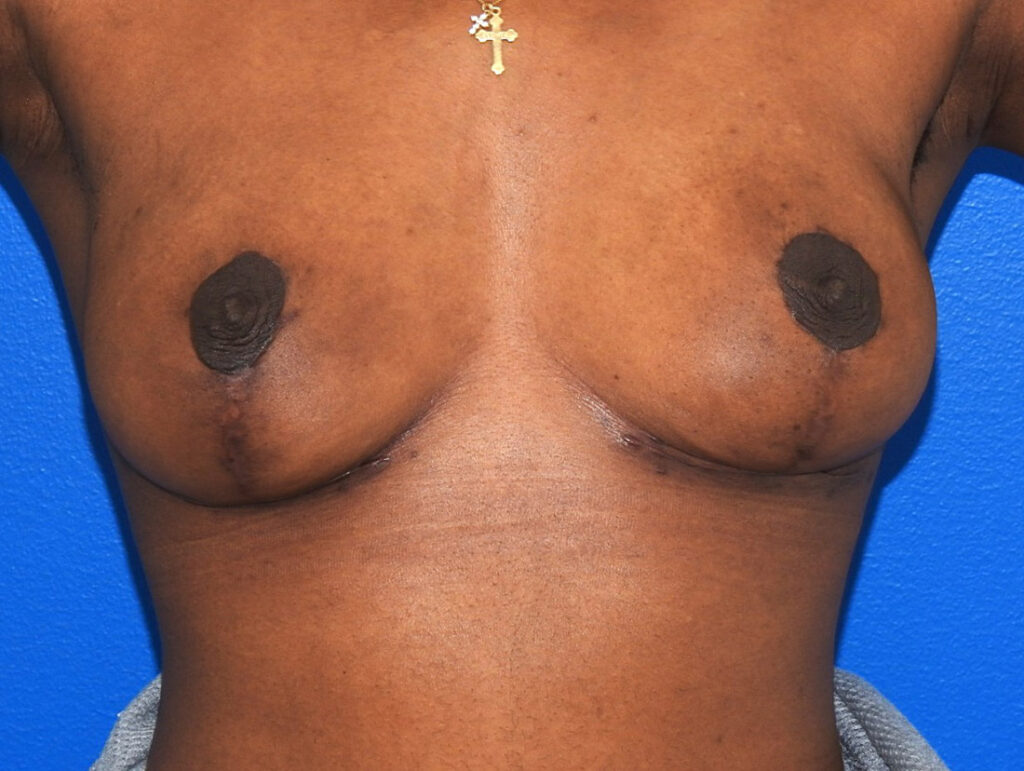 After Image: Patient Case #0191 - front