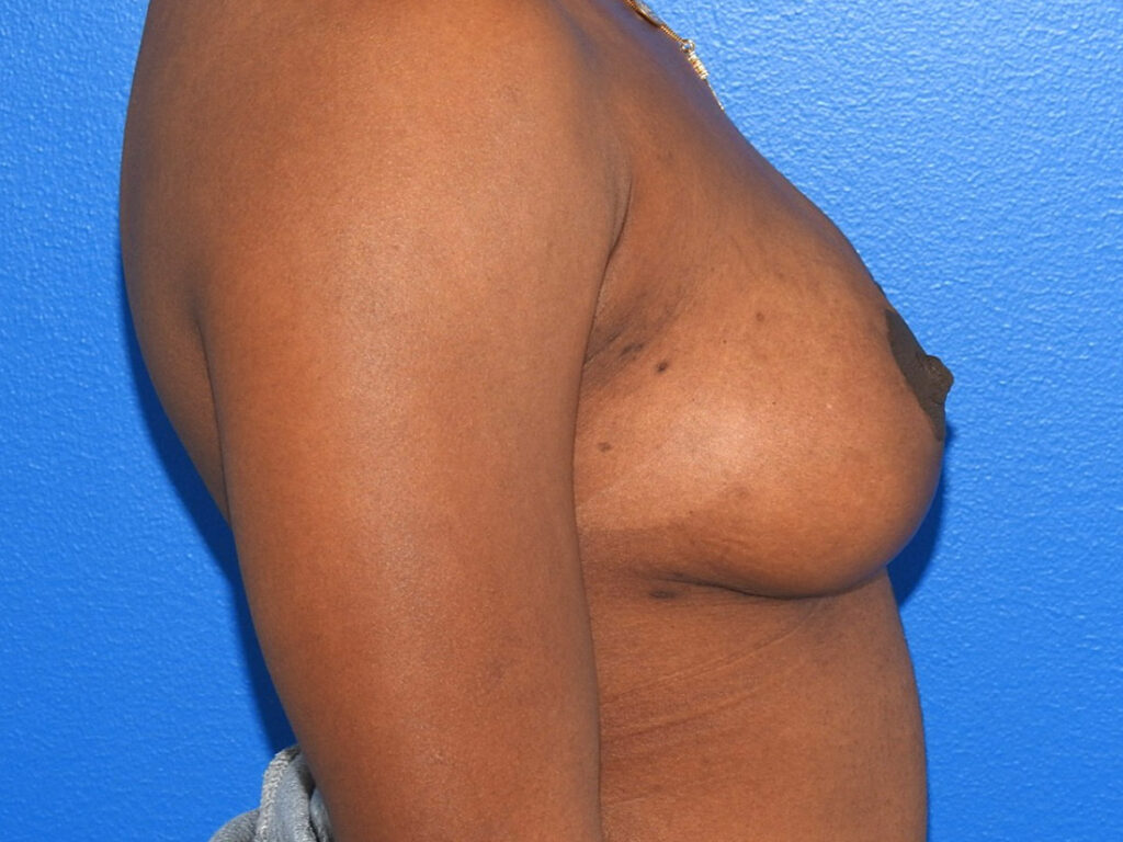 After Image: Patient Case #0191 - right-side