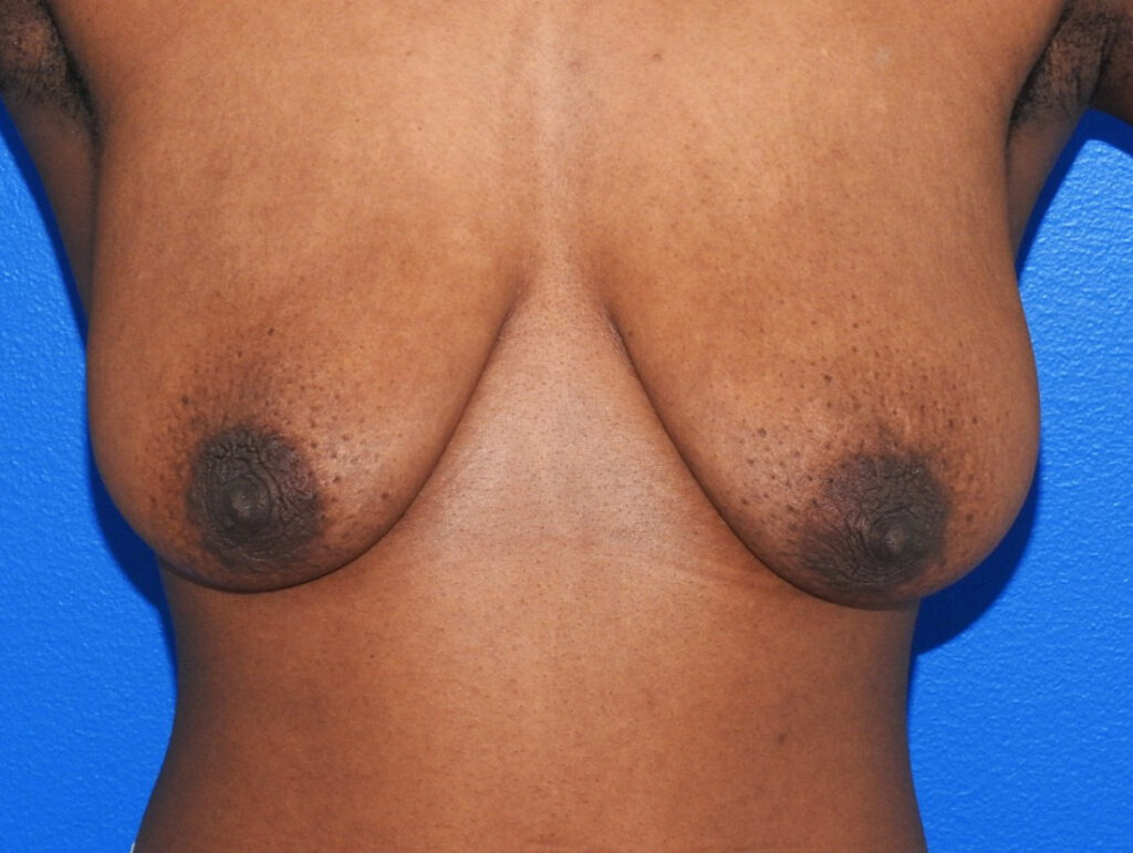 Before Image: Patient Case #0191 - front