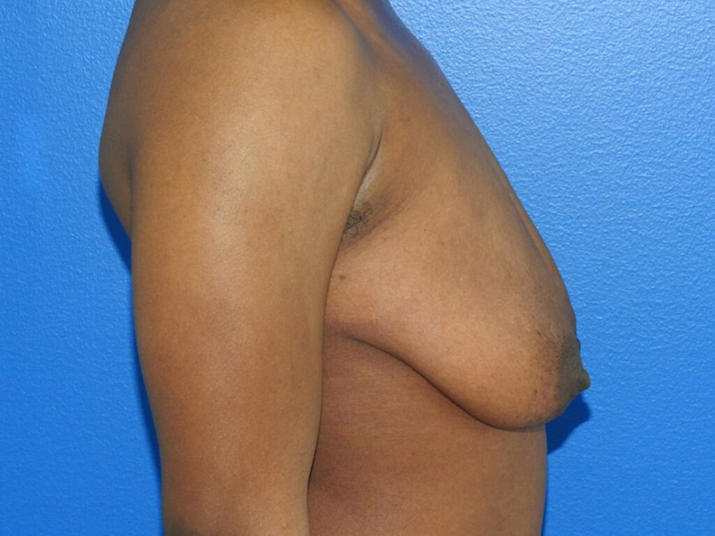 Before Image: Patient Case #0191 - right-side
