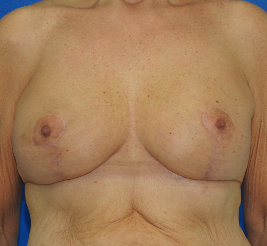 After Image: Patient Case #0192 - front
