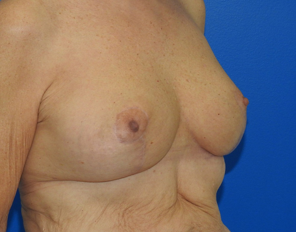 After Image: Patient Case #0192 - right-front-oblique
