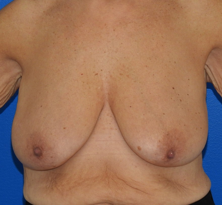 Before Image: Patient Case #0192 - front