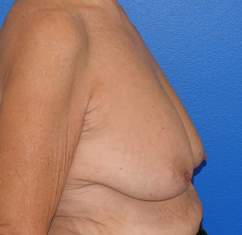Before Image: Patient Case #0192 - right-side